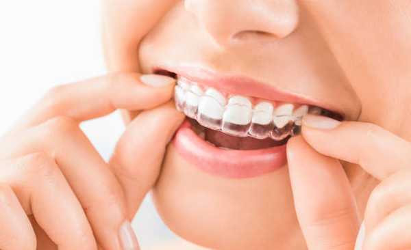 Affordable Teeth Straightening Options and Modern Braces: US Guide 2025